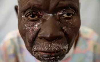 Kasus Mpox Sierra Leone Tembus 1.140, Pemerintah Perluas Vaksinasi WHO