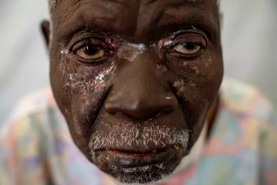 Penderita mpox di Afrika bertambah pesat. Kondisi itu diperparah dengan terlambatnya pengiriman vaksin. Total 622 orang telah meninggal dunia karena mpox di Afrika. (AP/Moses Sawasawa.)