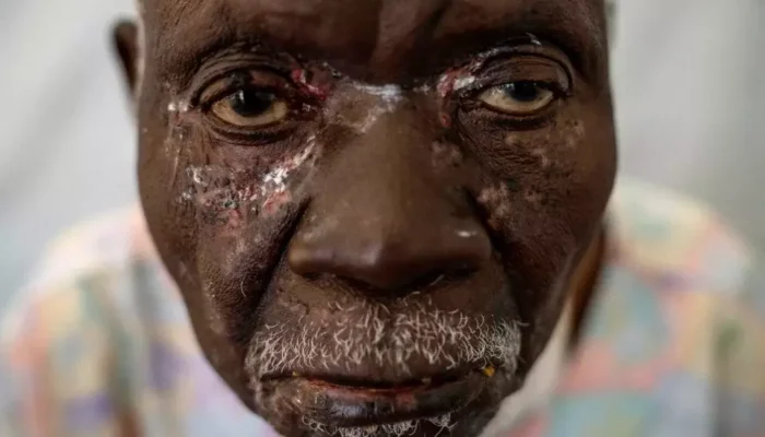 Kasus Mpox Sierra Leone Tembus 1.140, Pemerintah Perluas Vaksinasi WHO