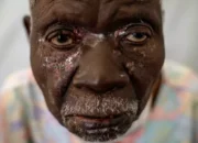 Kasus Mpox Sierra Leone Tembus 1.140, Pemerintah Perluas Vaksinasi WHO