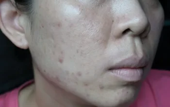 11 Cara Ampuh Menghilangkan Bekas Jerawat Hitam di Pipi, Coba Sekarang!