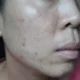 11 Cara Ampuh Menghilangkan Bekas Jerawat Hitam di Pipi, Coba Sekarang!