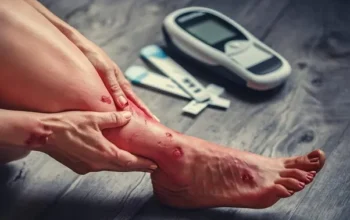 Waspada Luka Kaki Tak Kunjung Sembuh, Ini Tanda Komplikasi Diabetic Foot pada Penderita Diabetes