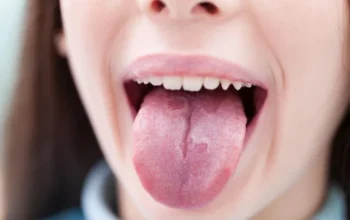 Waspadai Lidah Pecah Belah, Bisa Jadi Tanda Penyakit Ini